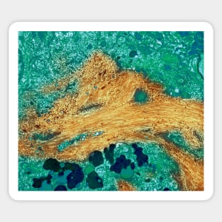 Alzheimer's disease brain cell, TEM (M108/0731) Sticker